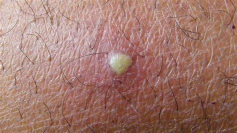 Please do not pop any pimples in your body. . Pus bumps on private area